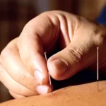 acupuncture