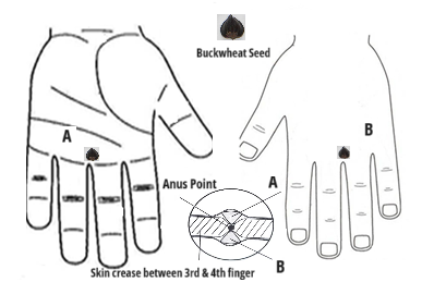 sujok therapy for hemorrhoid